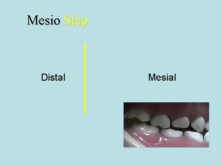 Mesio Step Distal Mesial 