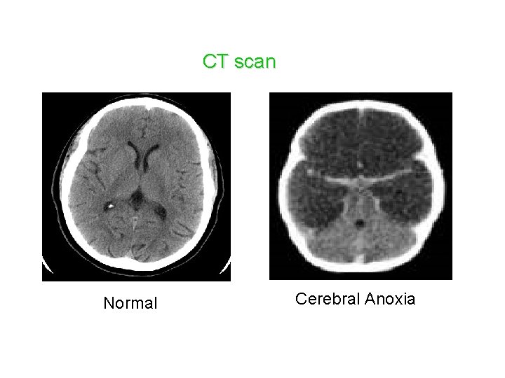 CT scan Normal Cerebral Anoxia 