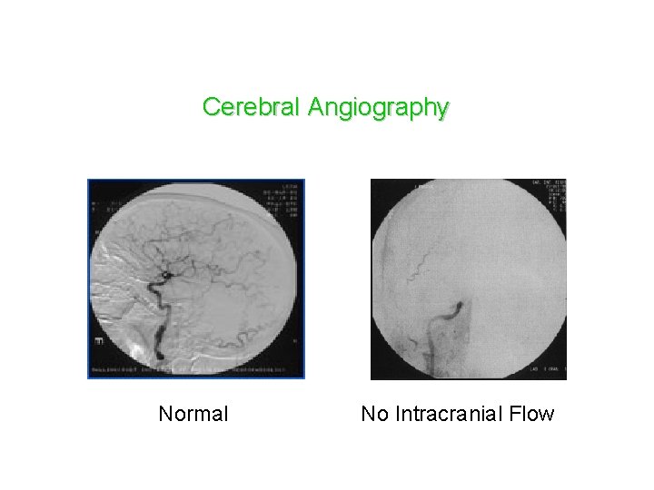 Cerebral Angiography Normal No Intracranial Flow 