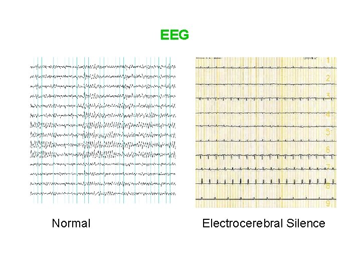 EEG Normal Electrocerebral Silence 