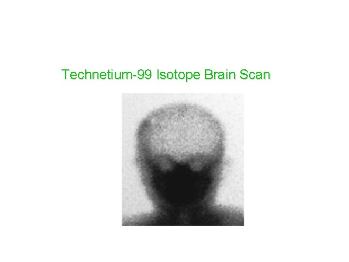 Technetium-99 Isotope Brain Scan 