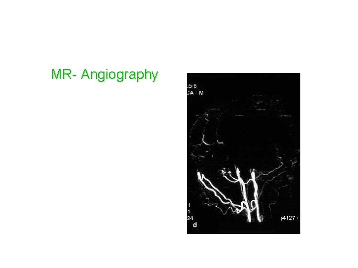 MR- Angiography 