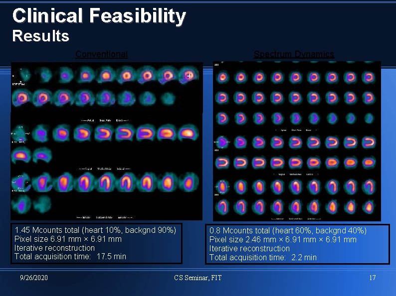 Clinical Feasibility Results Spectrum Dynamics Conventional 1. 45 Mcounts total (heart 10%, backgnd 90%)