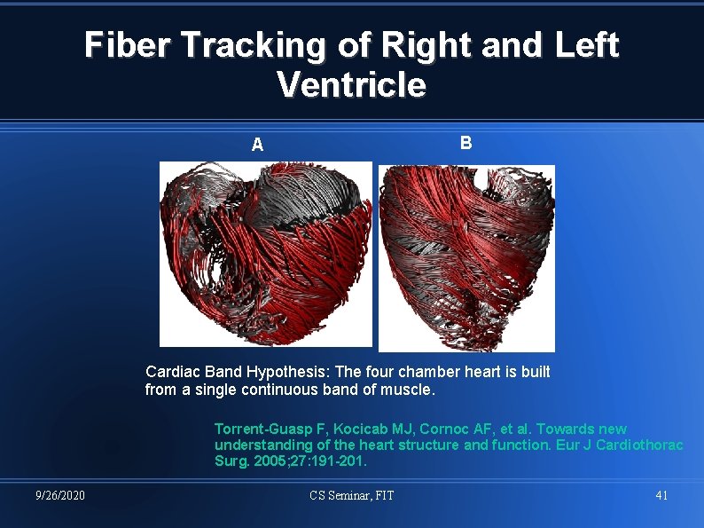Fiber Tracking of Right and Left Ventricle B A Cardiac Band Hypothesis: The four