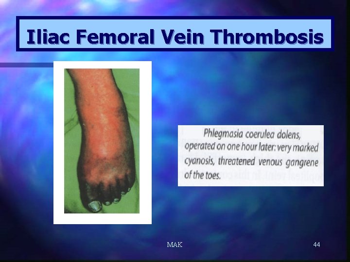 Iliac Femoral Vein Thrombosis MAK 44 