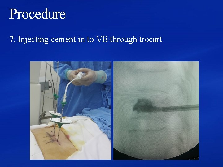 Procedure 7. Injecting cement in to VB through trocart 