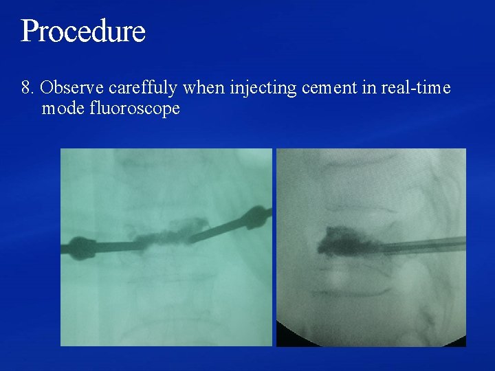 Procedure 8. Observe careffuly when injecting cement in real-time mode fluoroscope 