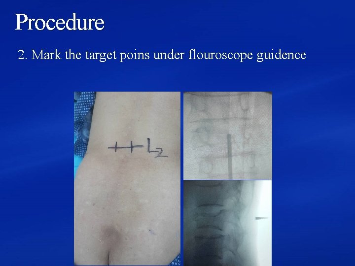 Procedure 2. Mark the target poins under flouroscope guidence 