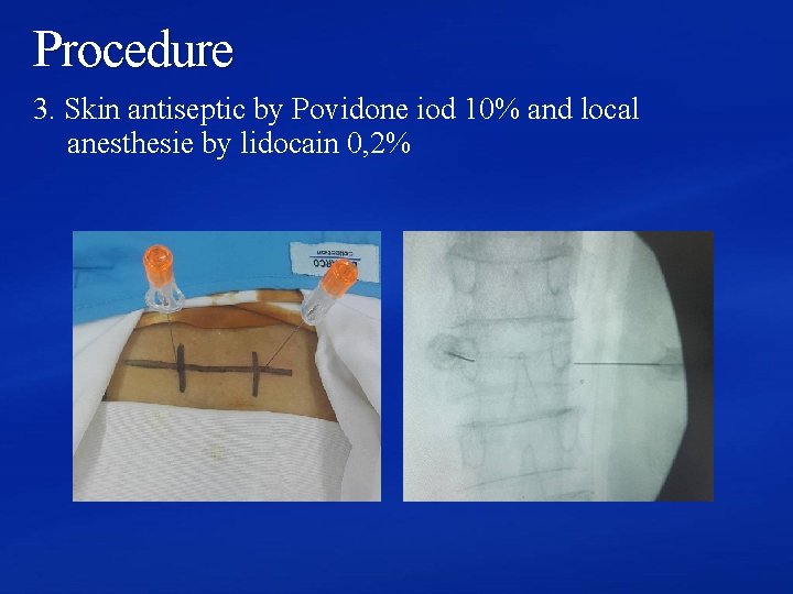 Procedure 3. Skin antiseptic by Povidone iod 10% and local anesthesie by lidocain 0,