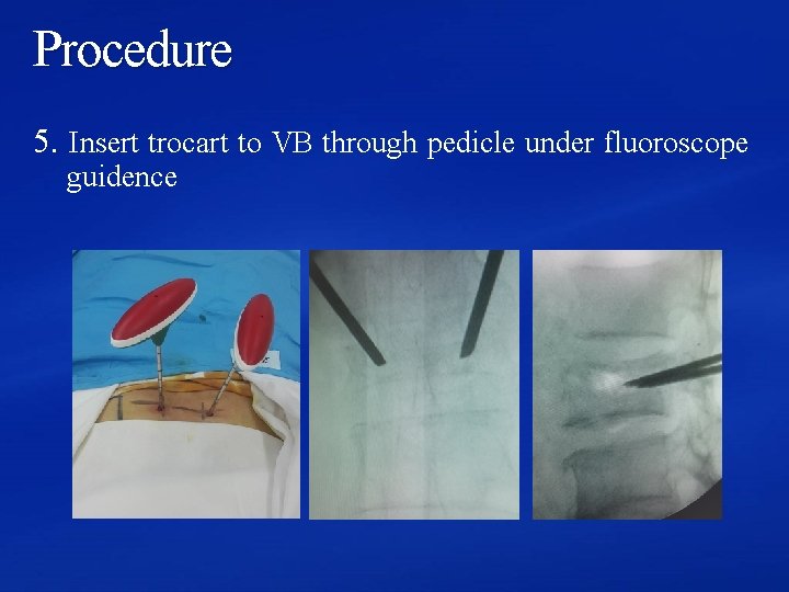 Procedure 5. Insert trocart to VB through pedicle under fluoroscope guidence 