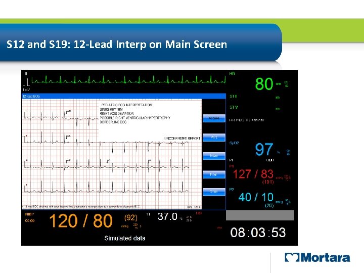 S 12 and S 19: 12 -Lead Interp on Main Screen Full Disclosure Window