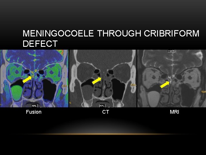 MENINGOCOELE THROUGH CRIBRIFORM DEFECT Fusion CT MRI 