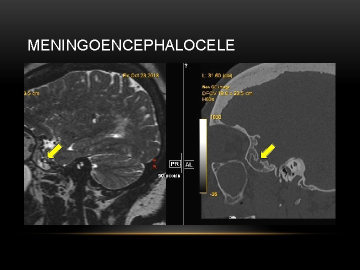 MENINGOENCEPHALOCELE 
