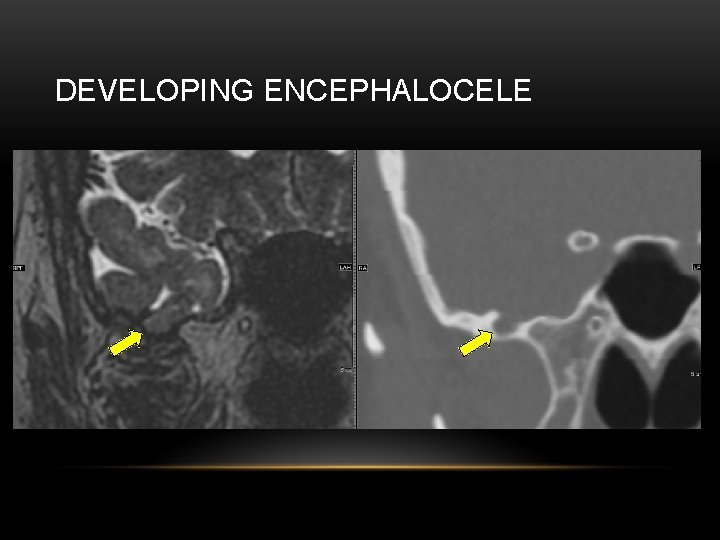 DEVELOPING ENCEPHALOCELE 
