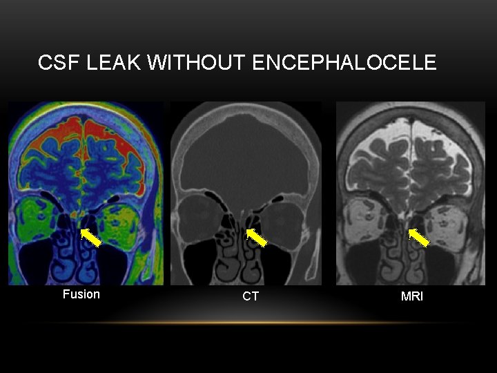 CSF LEAK WITHOUT ENCEPHALOCELE Fusion CT MRI 