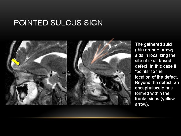 POINTED SULCUS SIGN The gathered sulci (thin orange arrow) aids in localizing the site