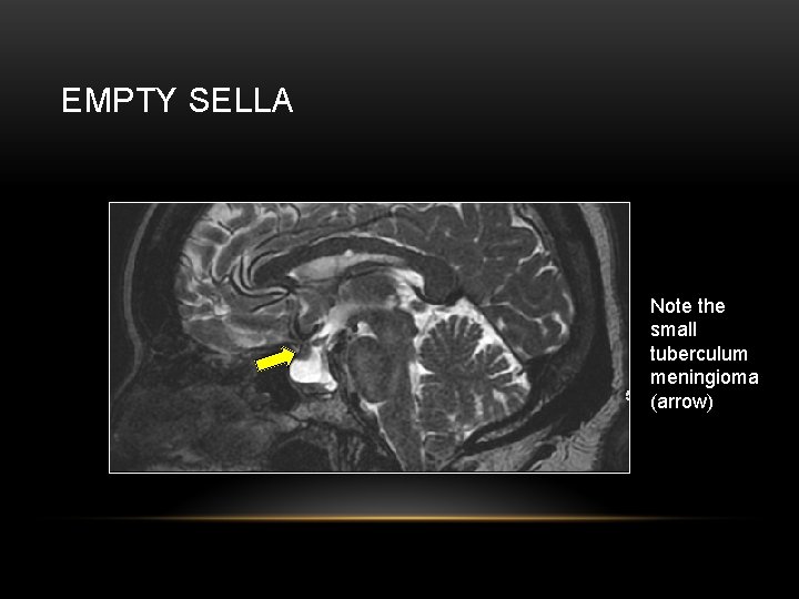 EMPTY SELLA Note the small tuberculum meningioma (arrow) 