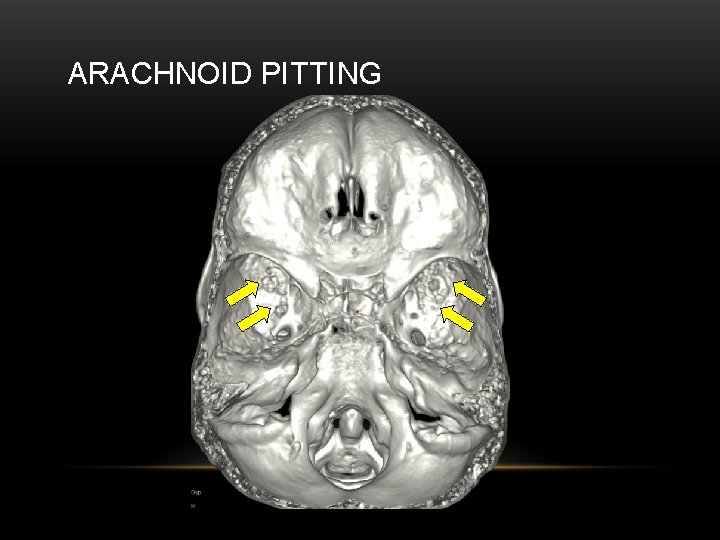 ARACHNOID PITTING 