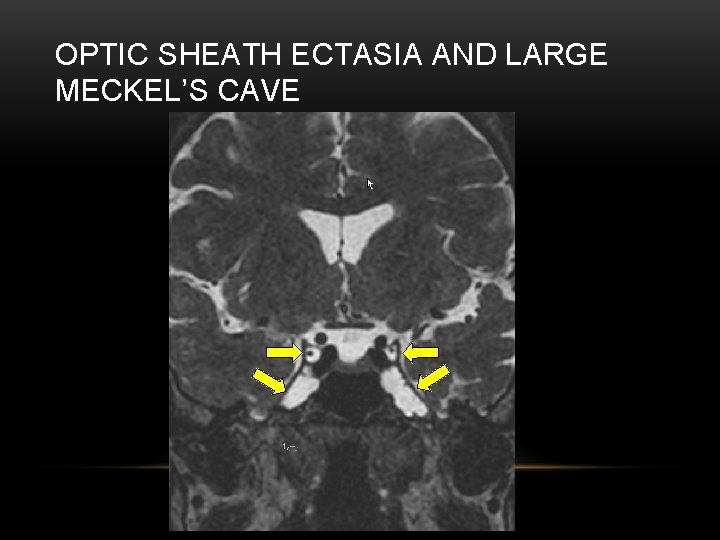 OPTIC SHEATH ECTASIA AND LARGE MECKEL’S CAVE 