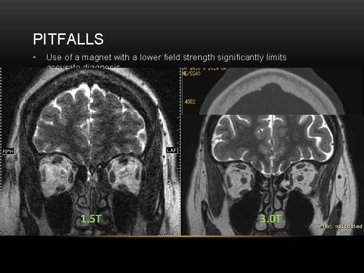 PITFALLS • Use of a magnet with a lower field strength significantly limits accurate