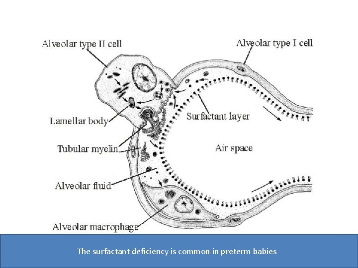 The surfactant deficiency is common in preterm babies 