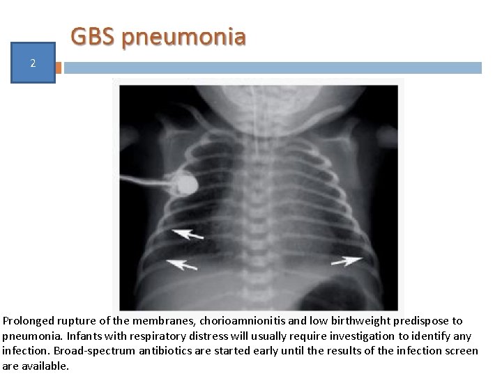 2 Prolonged rupture of the membranes, chorioamnionitis and low birthweight predispose to pneumonia. Infants