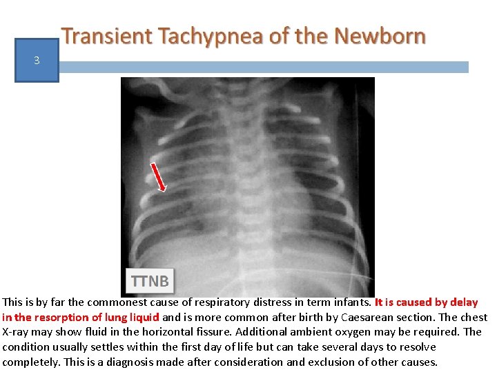 3 This is by far the commonest cause of respiratory distress in term infants.