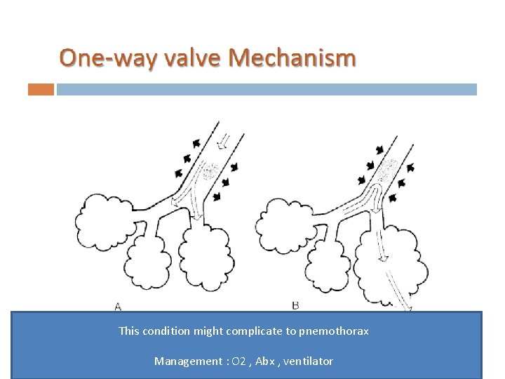 This condition might complicate to pnemothorax Management : O 2 , Abx , ventilator