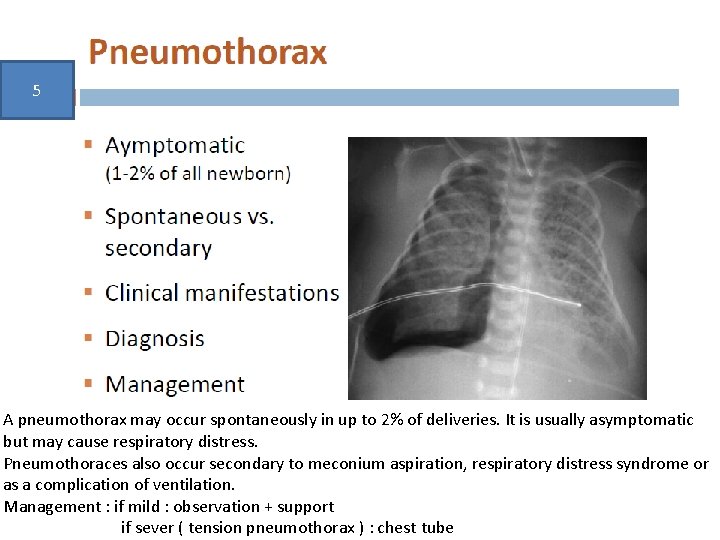 5 A pneumothorax may occur spontaneously in up to 2% of deliveries. It is