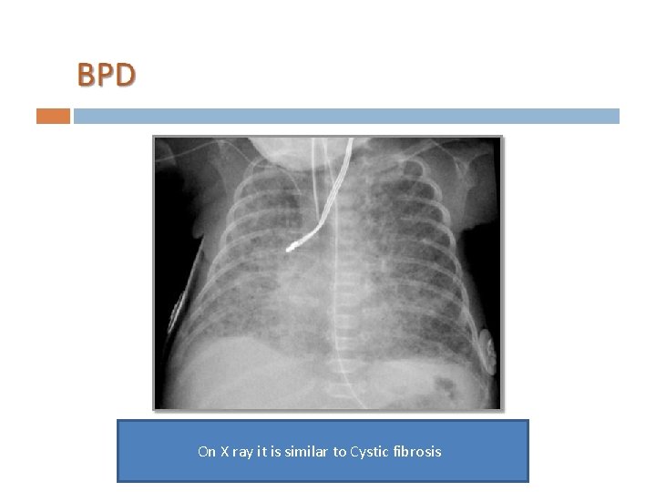 On X ray it is similar to Cystic fibrosis 