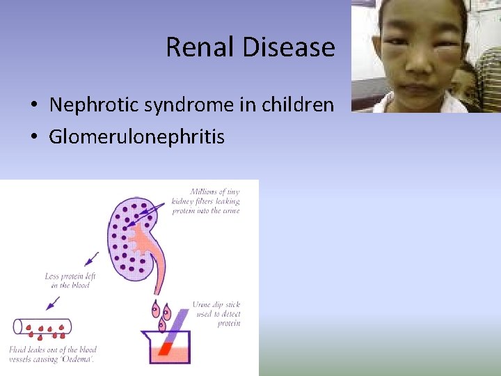 Renal Disease • Nephrotic syndrome in children • Glomerulonephritis 