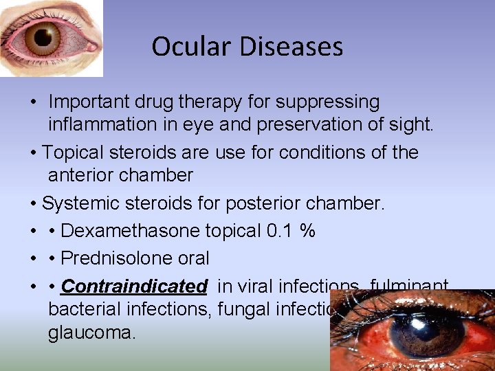 Ocular Diseases • Important drug therapy for suppressing inflammation in eye and preservation of