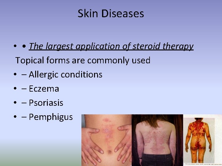 Skin Diseases • • The largest application of steroid therapy Topical forms are commonly