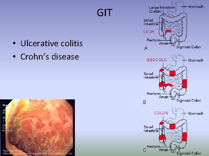 GIT • Ulcerative colitis • Crohn’s disease 