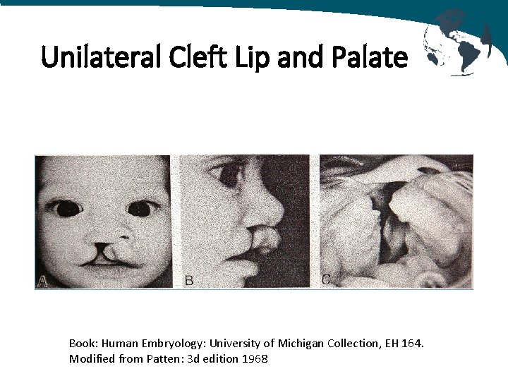 Unilateral Cleft Lip and Palate Book: Human Embryology: University of Michigan Collection, EH 164.