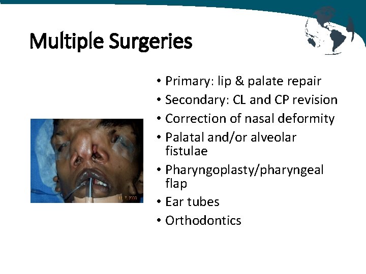 Multiple Surgeries • Primary: lip & palate repair • Secondary: CL and CP revision