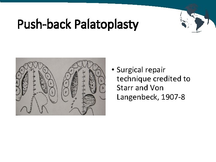 Push-back Palatoplasty • Surgical repair technique credited to Starr and Von Langenbeck, 1907 -8