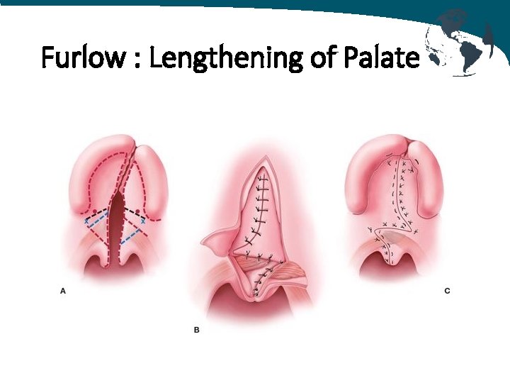 Furlow : Lengthening of Palate 