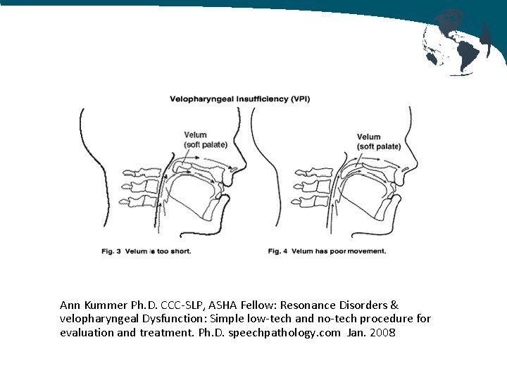 Ann Kummer Ph. D. CCC-SLP, ASHA Fellow: Resonance Disorders & velopharyngeal Dysfunction: Simple low-tech