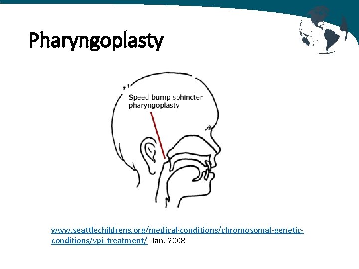 Pharyngoplasty www. seattlechildrens. org/medical-conditions/chromosomal-geneticconditions/vpi-treatment/ Jan. 2008 