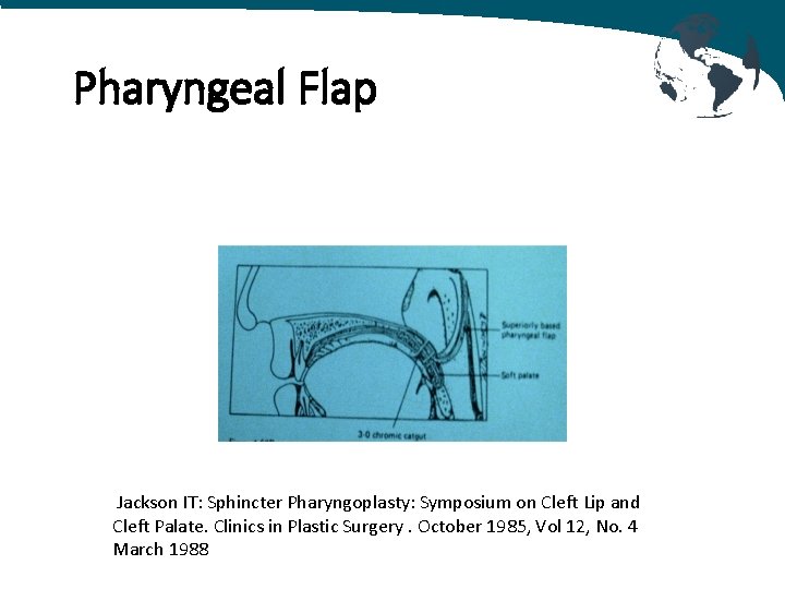 Pharyngeal Flap Jackson IT: Sphincter Pharyngoplasty: Symposium on Cleft Lip and Cleft Palate. Clinics