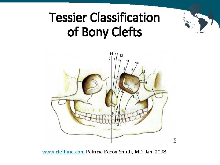 Tessier Classification of Bony Clefts www. cleftline. com Patricia Bacon Smith, MD. Jan. 2008