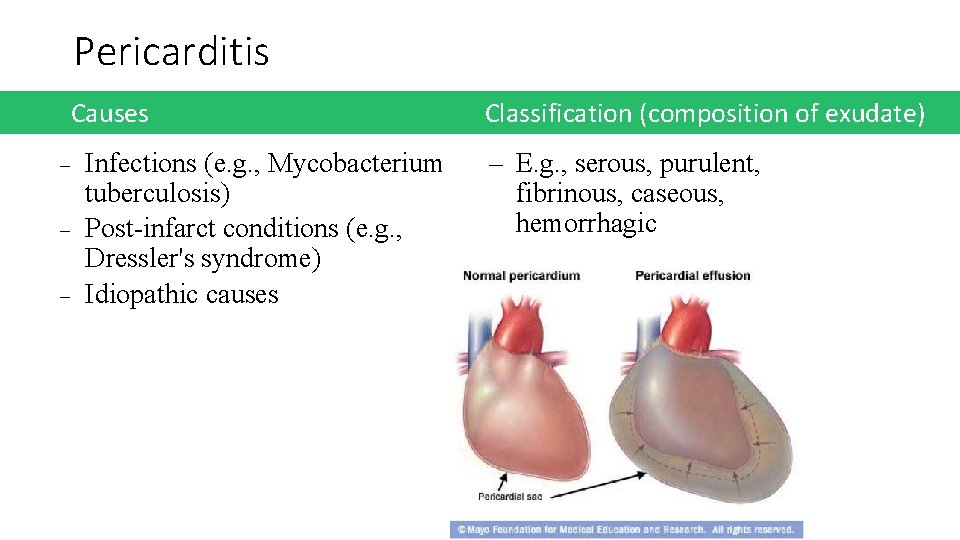 Pericarditis Causes Classification (composition of exudate) Infections (e. g. , Mycobacterium tuberculosis) Post-infarct conditions