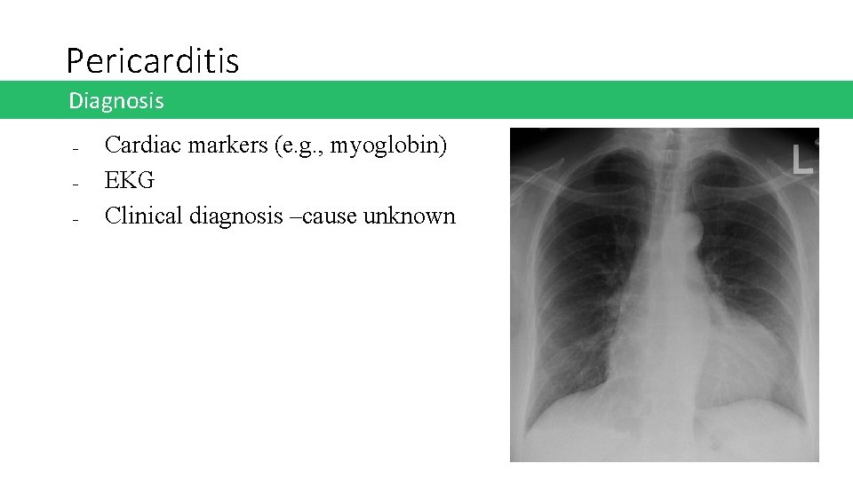 Pericarditis Diagnosis ‒ ‒ ‒ Cardiac markers (e. g. , myoglobin) EKG Clinical diagnosis