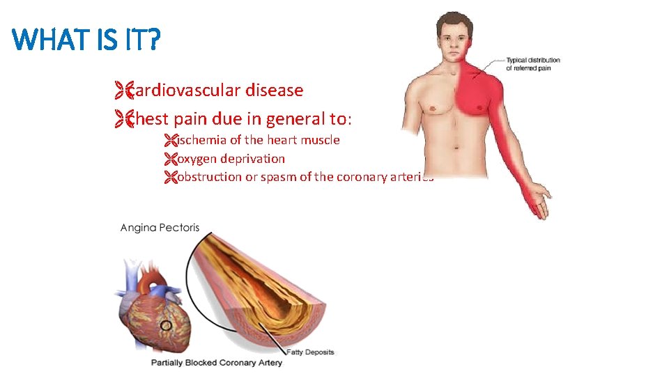 WHAT IS IT? Ëcardiovascular disease Ëchest pain due in general to: Ëischemia of the