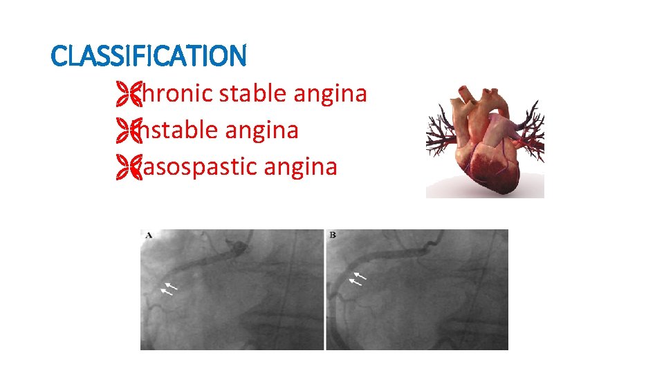 CLASSIFICATION Ëchronic stable angina Ëinstable angina Ëvasospastic angina 