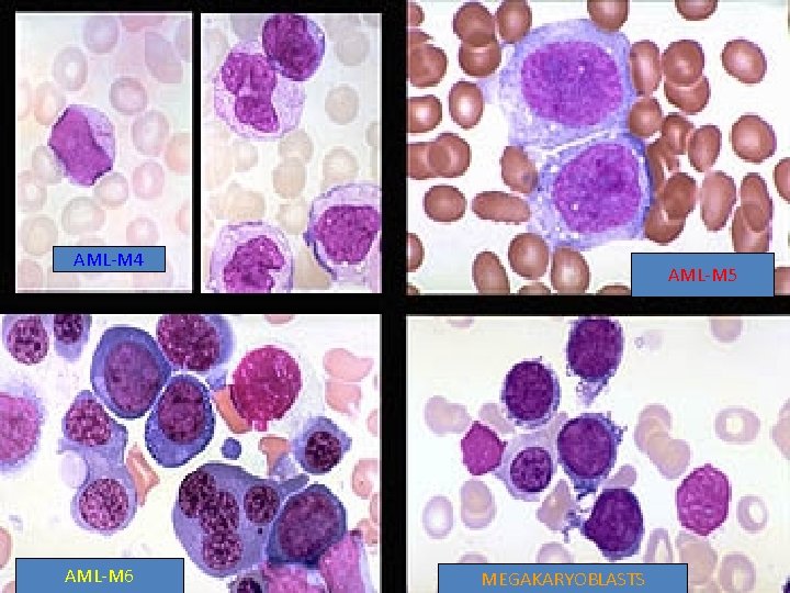 AML-M 4 AML-M 6 AML-M 5 MEGAKARYOBLASTS 