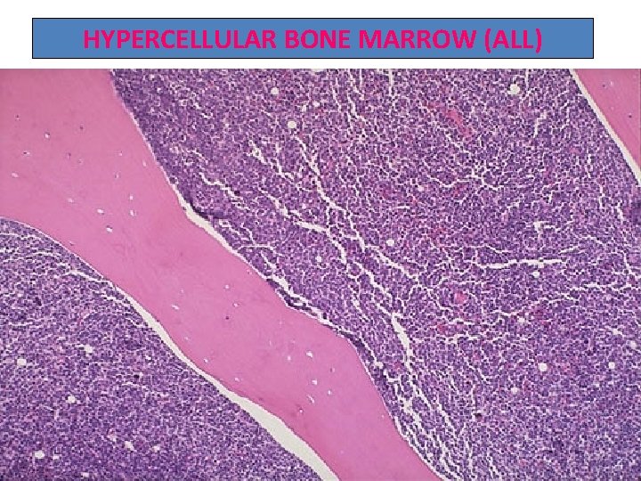 HYPERCELLULAR BONE MARROW (ALL) 