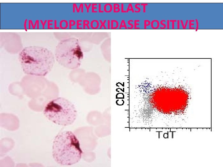 MYELOBLAST (MYELOPEROXIDASE POSITIVE) 