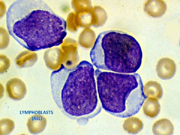 LYMPHOBLASTS (ALL) 